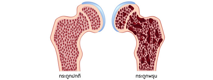 ผลการค้นหารูปภาพสำหรับ โรคกระดูกพรุน