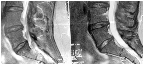 กระดูกเอว กระดูกสันหลังเอว กระดูกบั้นเอว <a href='https://www.honestdocs.co/pelvic-nerves-compress-the-nerve' target='_blank'>กระดูกเอว</a> กระดูกสันหลังเอว กระดูกบั้นเอว