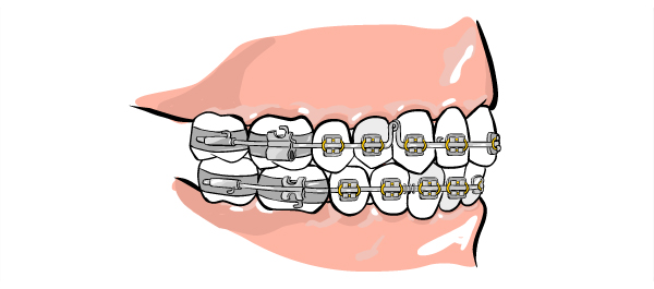 จัดฟันออนไลน์ฟันตายในปาก จัดฟันออนไลน์ฟันตายในปาก