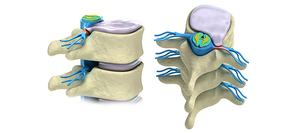 ช่องระหว่างกระดูกสันหลัง ช่องระหว่างกระดูกสันหลัง