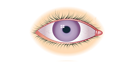 ต้อลำไย ต้อลำไย