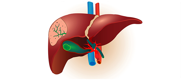 ทางเดินน้ำดีตีบตัน  ทางเดินน้ำดีตีบตัน