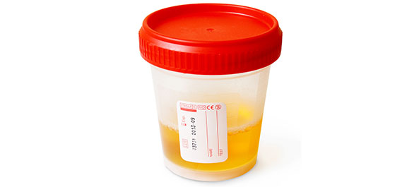 ทางเดินปัสสาวะติดเชื้อ-3 ทางเดินปัสสาวะติดเชื้อ-3