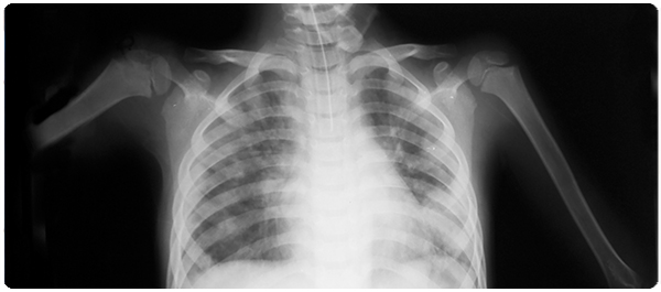 นิวมอเนีย