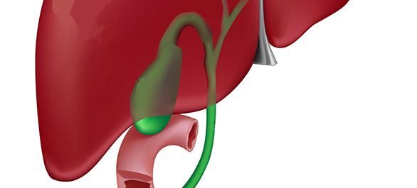 นิ่วในถุงน้ำดี-4 นิ่วในถุงน้ำดี-4