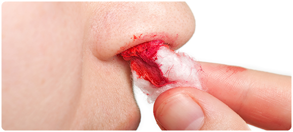 น้ำมูกเป็นเลือด น้ำมูกเป็นเลือด