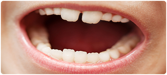 น้ำลายเทียม