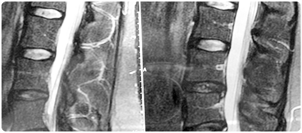 บิสฟอสโฟเนท บิสฟอสโฟเนท