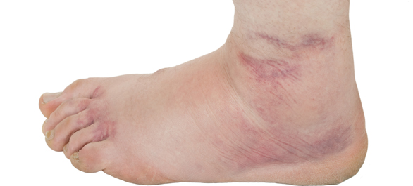 ปวดเท้า