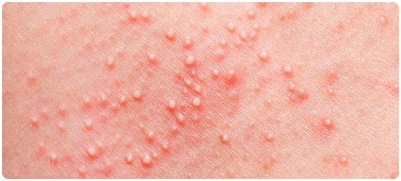 ผิวหนังอักเสบ ผิวหนังอักเสบ