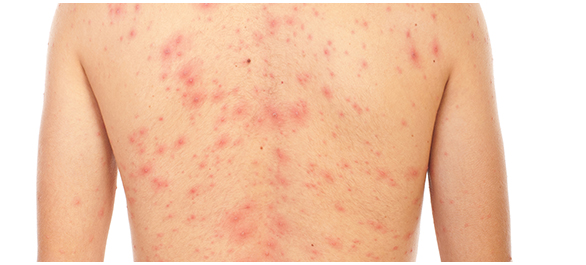 ผื่น ผื่น