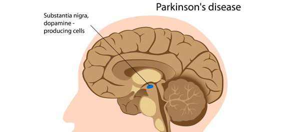<a href='https://www.honestdocs.co/what-is-tardive-dyskinesia' target='_blank'>พาร์กินสัน</a>-26