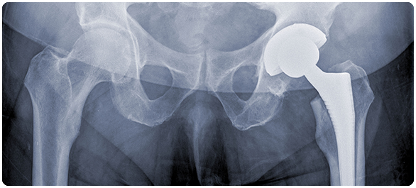 มวลกระดูก มวลกระดูก