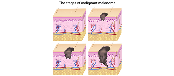 มะเร็งผิวหนังจากแดดจ้า มะเร็งผิวหนังจากแดดจ้า