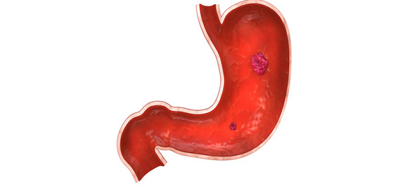 ยาเคลือบกระเพาะอาหาร ยาเคลือบกระเพาะอาหาร