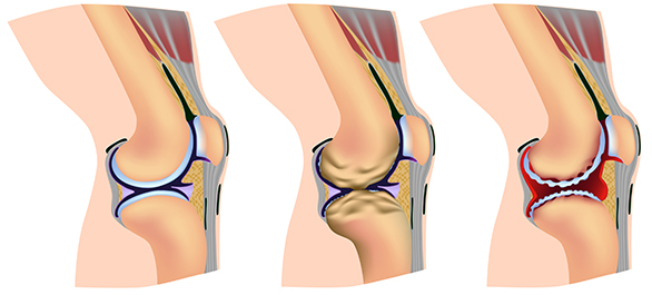 มาร์แฟน-ซินโดรม