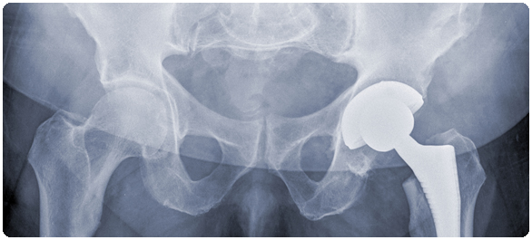 สะโพกหัก โรคฮิตของคนแก่ สะโพกหัก โรคฮิตของคนแก่