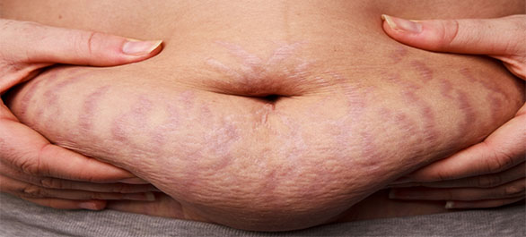 หนังท้องตึงหนังตาหย่อน-2 หนังท้องตึงหนังตาหย่อน-2