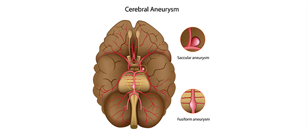 หลอดเลือดแดงโป่งพอง หลอดเลือดแดงโป่งพอง