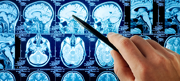 อะโครเมกาลี-โรคใหญ่โตแต่หายาก-4 อะโครเมกาลี-โรคใหญ่โตแต่หายาก-4