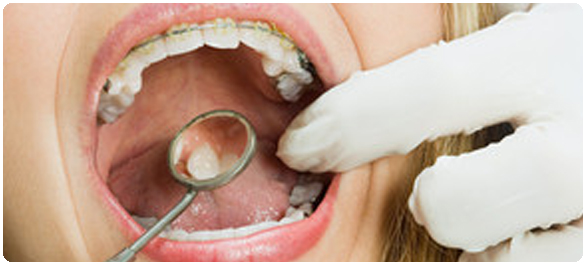 เลือดออกตามไรฟัน <a href='https://www.honestdocs.co/how-to-brush-your-teeth' target='_blank'>เลือดออกตามไรฟัน</a>