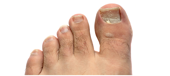 เล็บขบ เล็บขบ