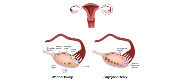 เอ๊ะเกี่ยวกันได้ไงแป้งฝุ่นกับมะเร็งรังไข่ เอ๊ะเกี่ยวกันได้ไงแป้งฝุ่นกับมะเร็งรังไข่