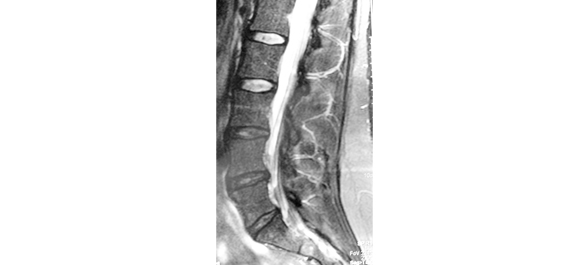 <a href='https://www.honestdocs.co/what-is-laminectomy' target='_blank'>โพรงกระดูกสันหลัง</a>