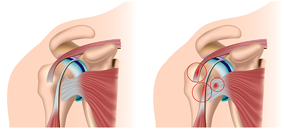 ไหล่ติด ติดไหล่-1 ไหล่ติด ติดไหล่-1