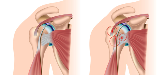 ไหล่ติด ติดไหล่-2