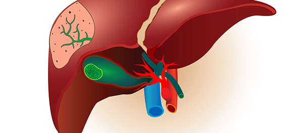 นิ่วในถุงน้ำดี_4 นิ่วในถุงน้ำดี_4